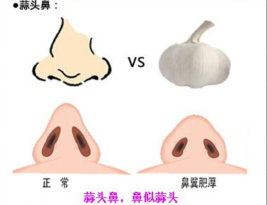 蒜头鼻整形方法有哪些？多少钱？