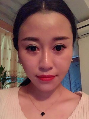 福州爱美尔医疗美容张胜利面部吸脂案例分享